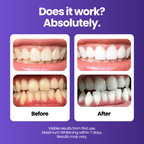 Purple Whitening Strips